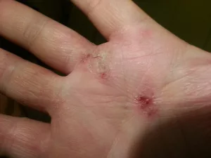 Lee más sobre el artículo Grave epidemia de dermatitis en la prisión La Condesa.